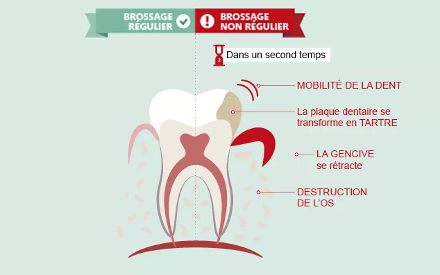 Comprendre la maladie des gencives