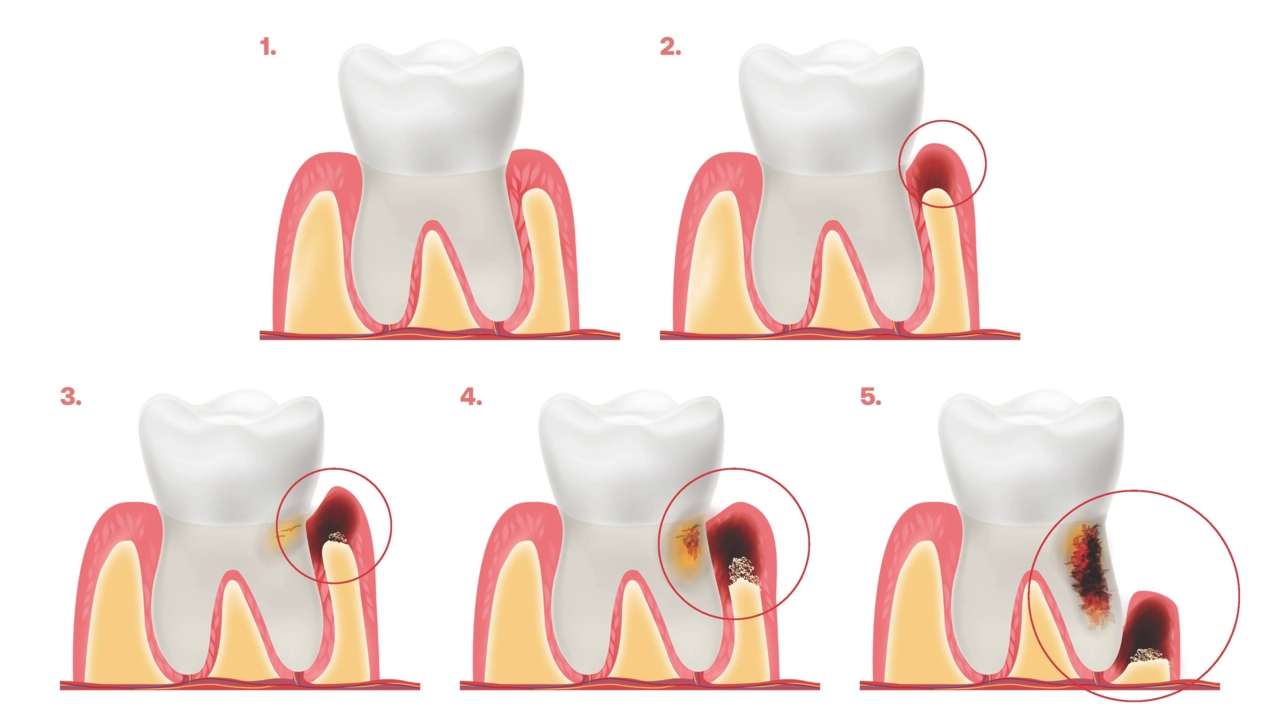 L’évolution de la parodontite