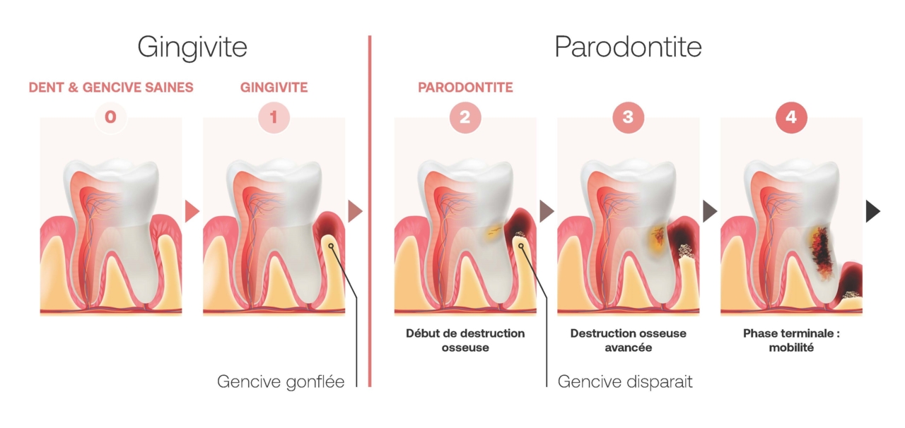 Comment traiter la parodontite ?