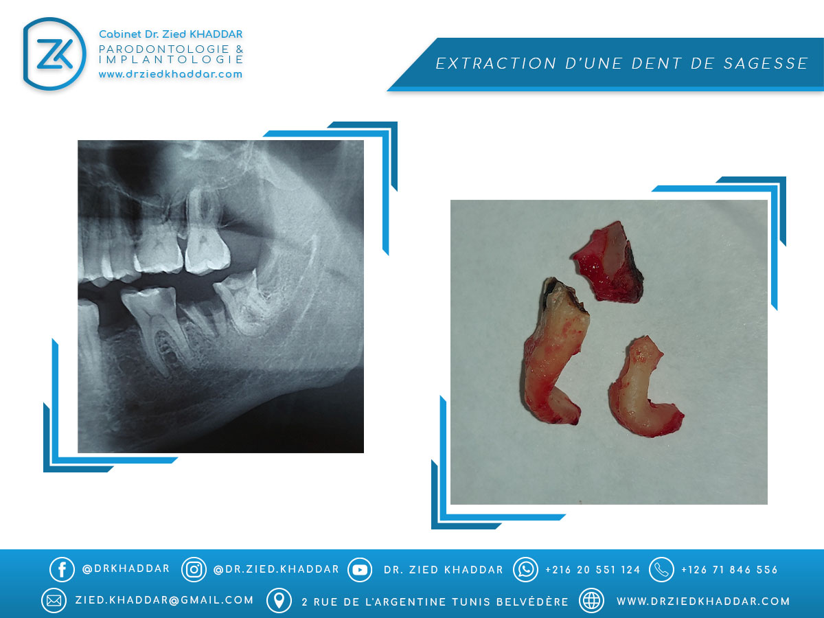 Extraction d’une dent de sagesse 