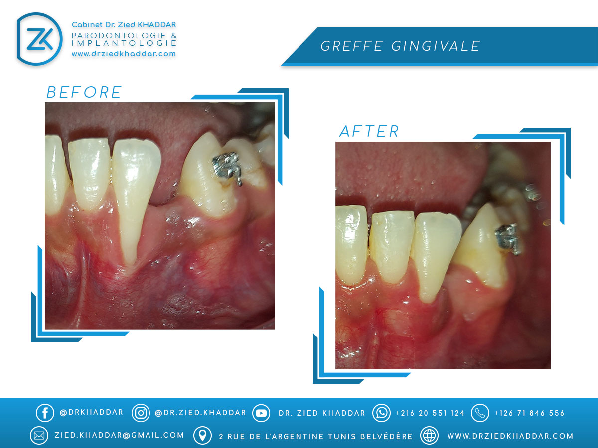 Greffe gingivale 