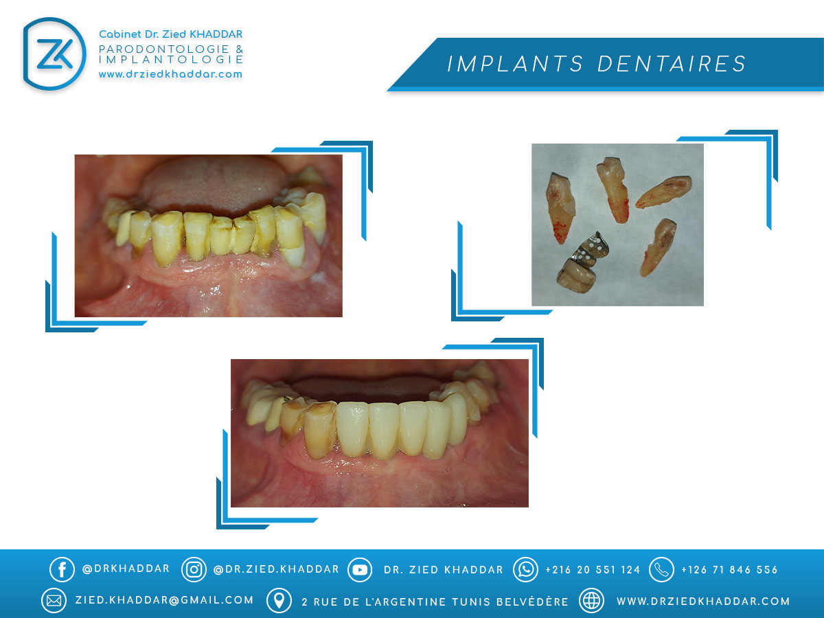 Implants dentaires 