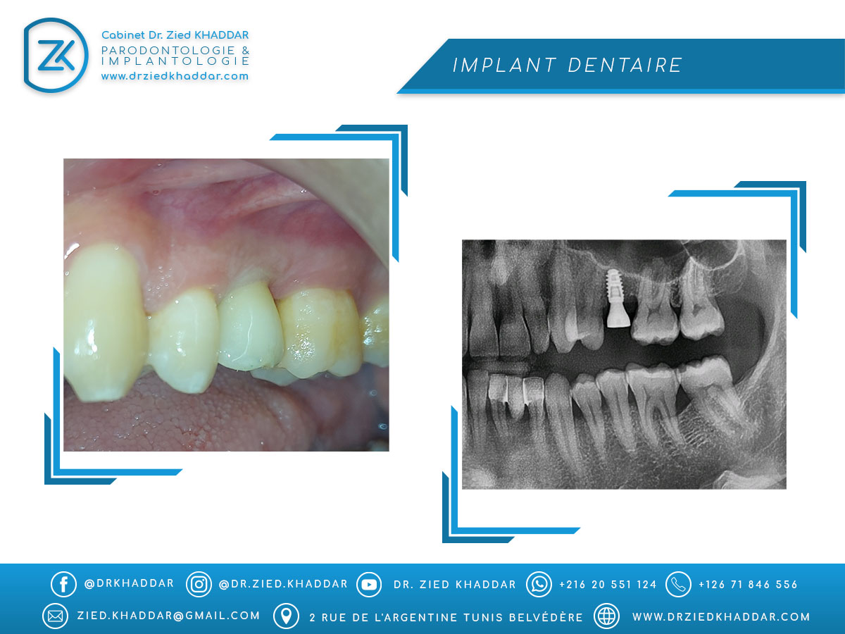 Implant dentaire