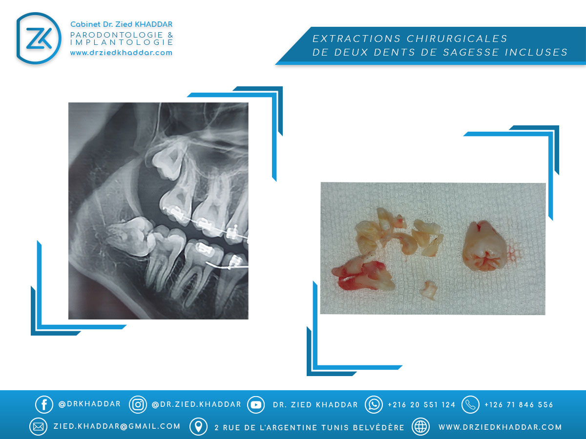 Extractions chirurgicales de deux dents de sagesse incluses