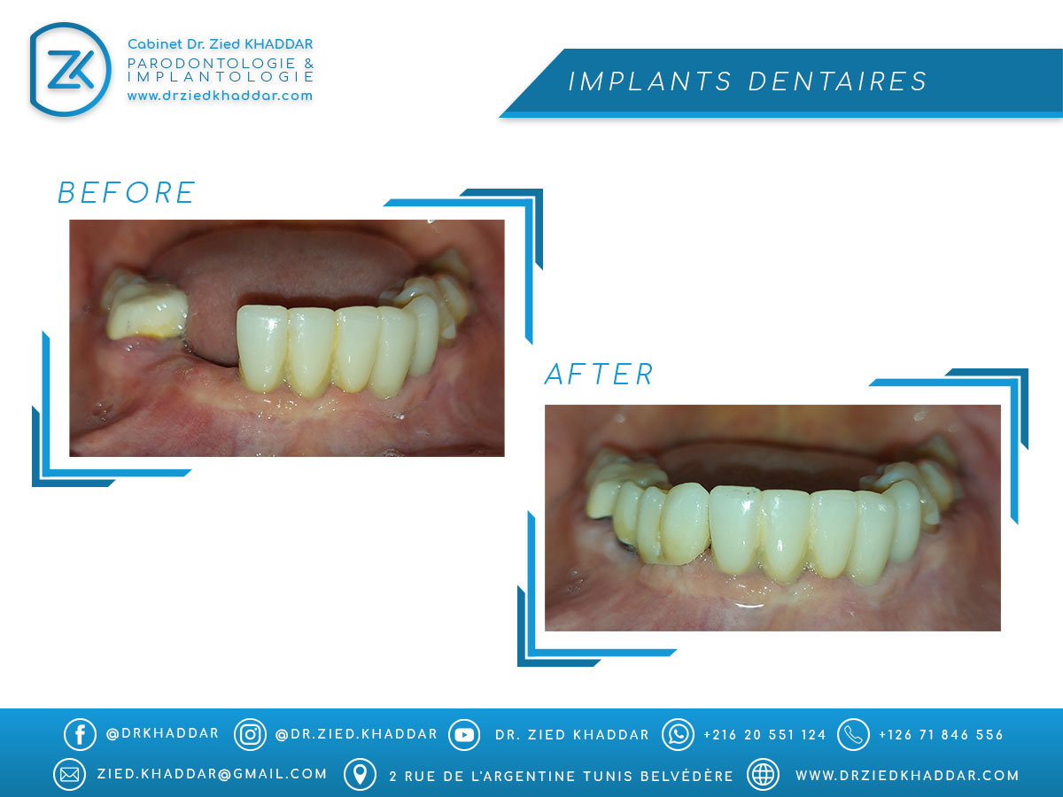 Implants dentaires 