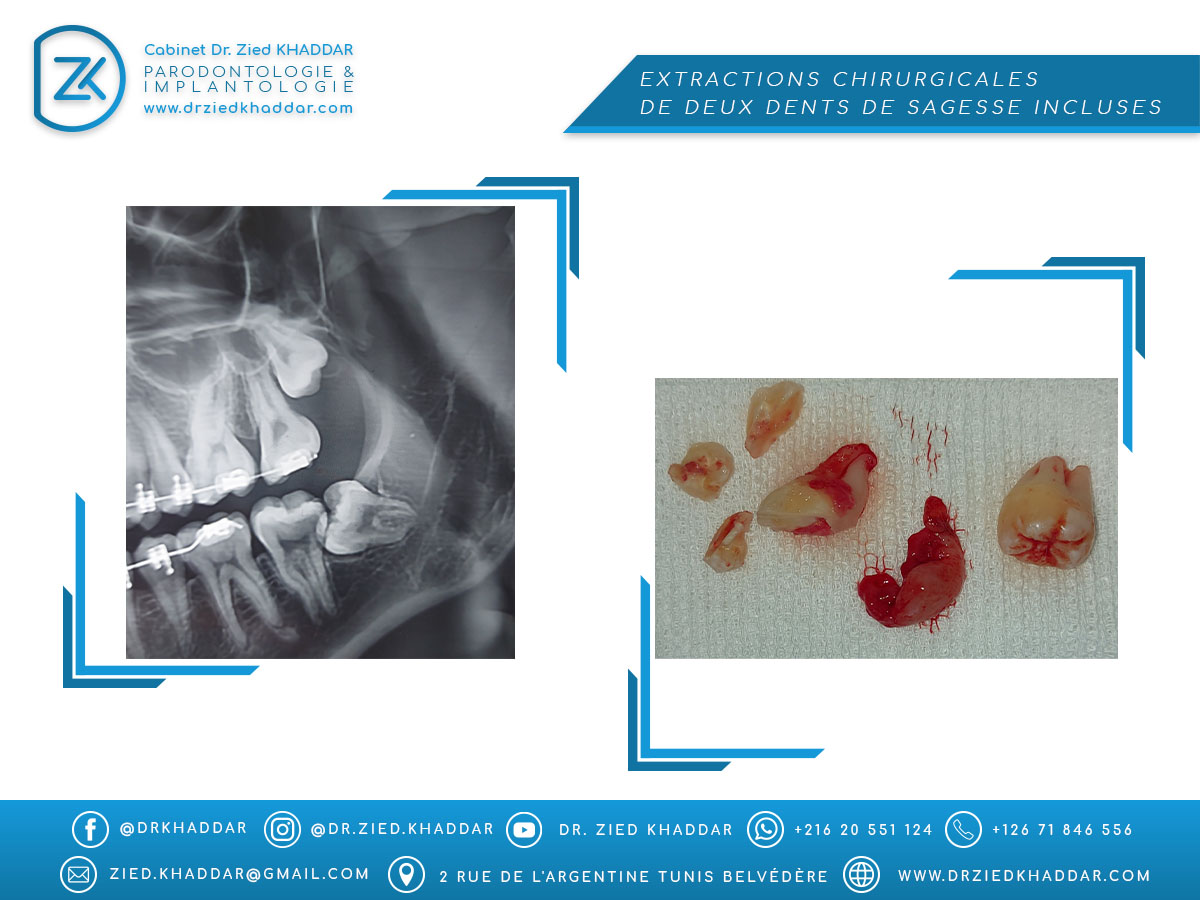 Extractions chirurgicales de deux dents de sagesse incluses