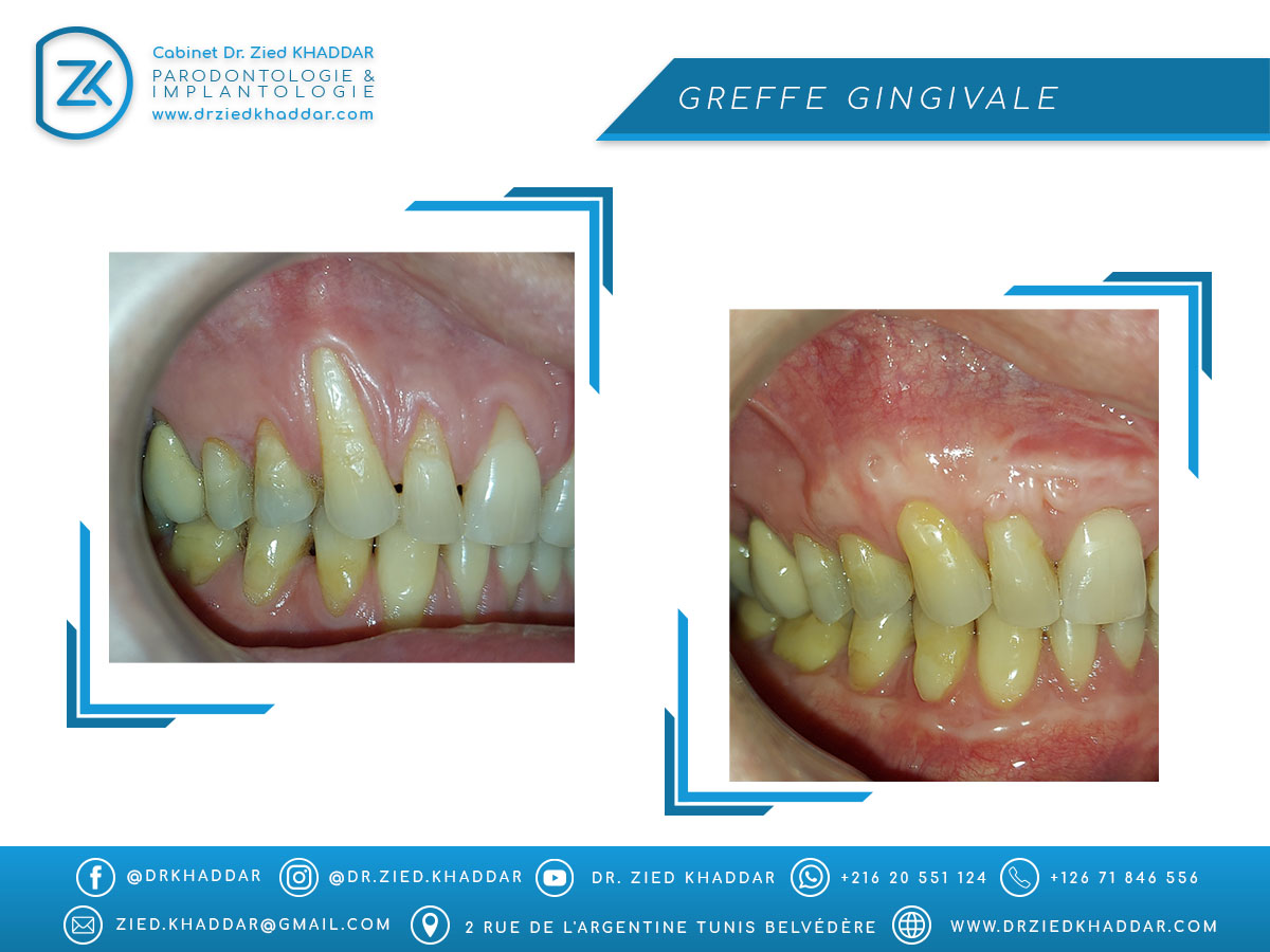 Greffe gingivale 