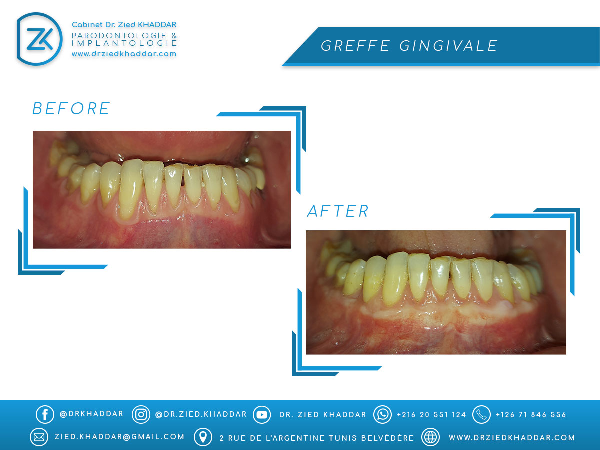 Greffe gingivale 