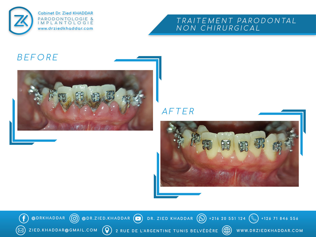 Traitement parodontal non chirurgical