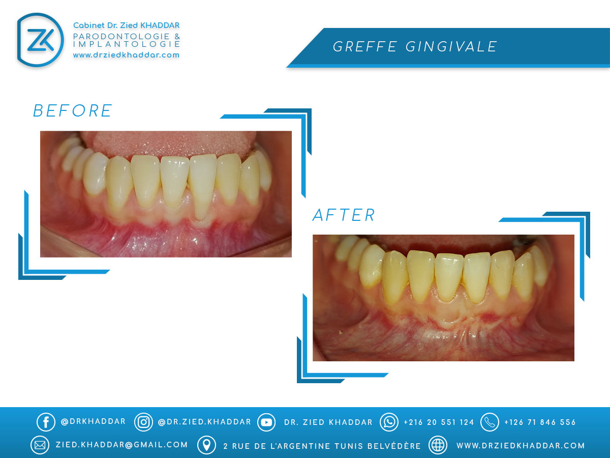 Greffe gingivale 