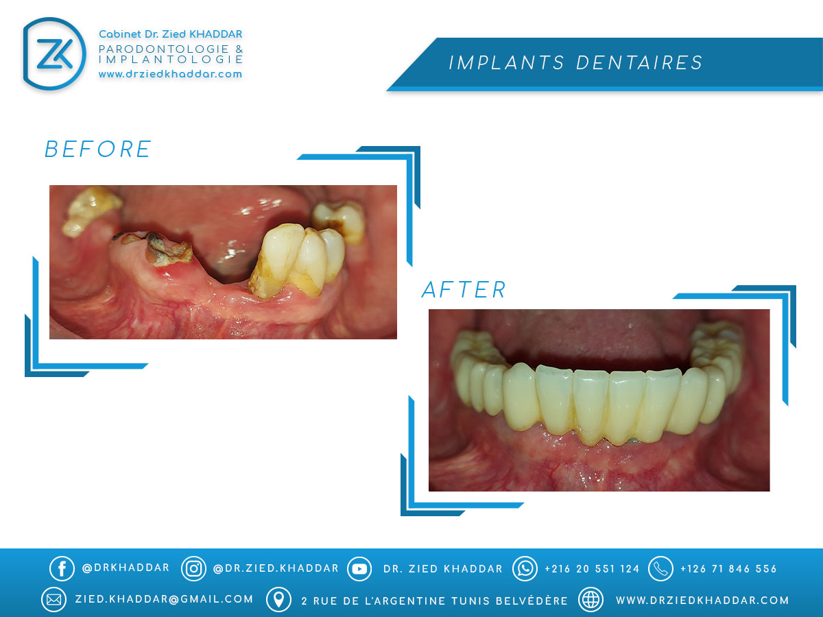Implants dentaires 