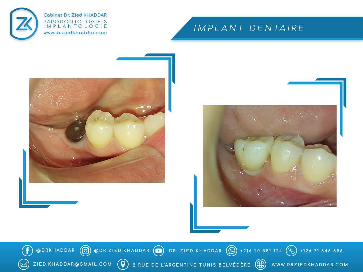 Implant dentaire