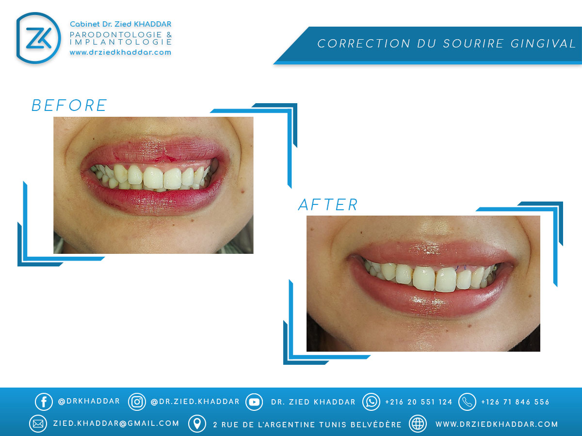 Correction du sourire gingival 