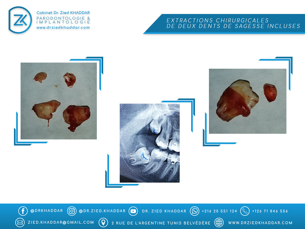 Extractions chirurgicales de deux dents de sagesse incluses