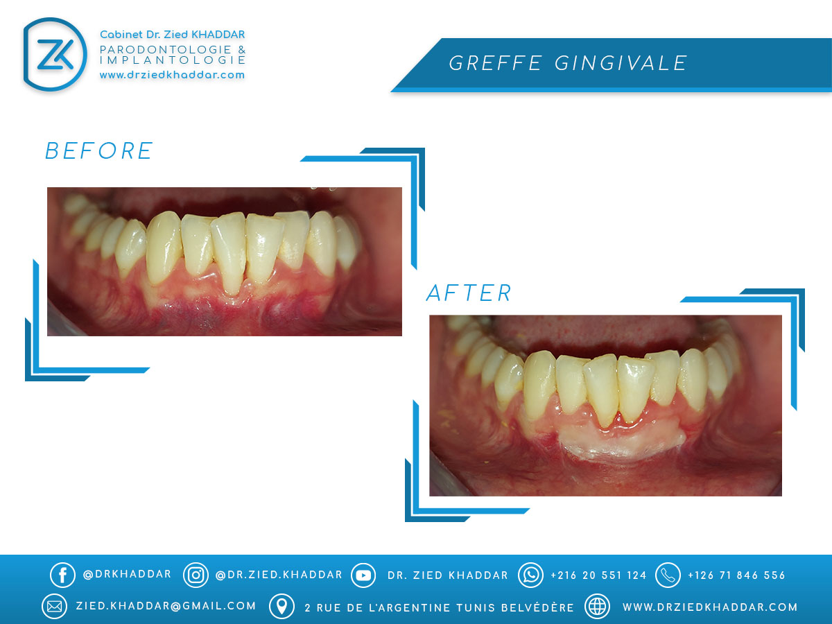 Greffe gingivale 