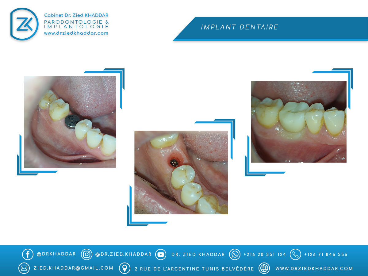 Implant dentaire
