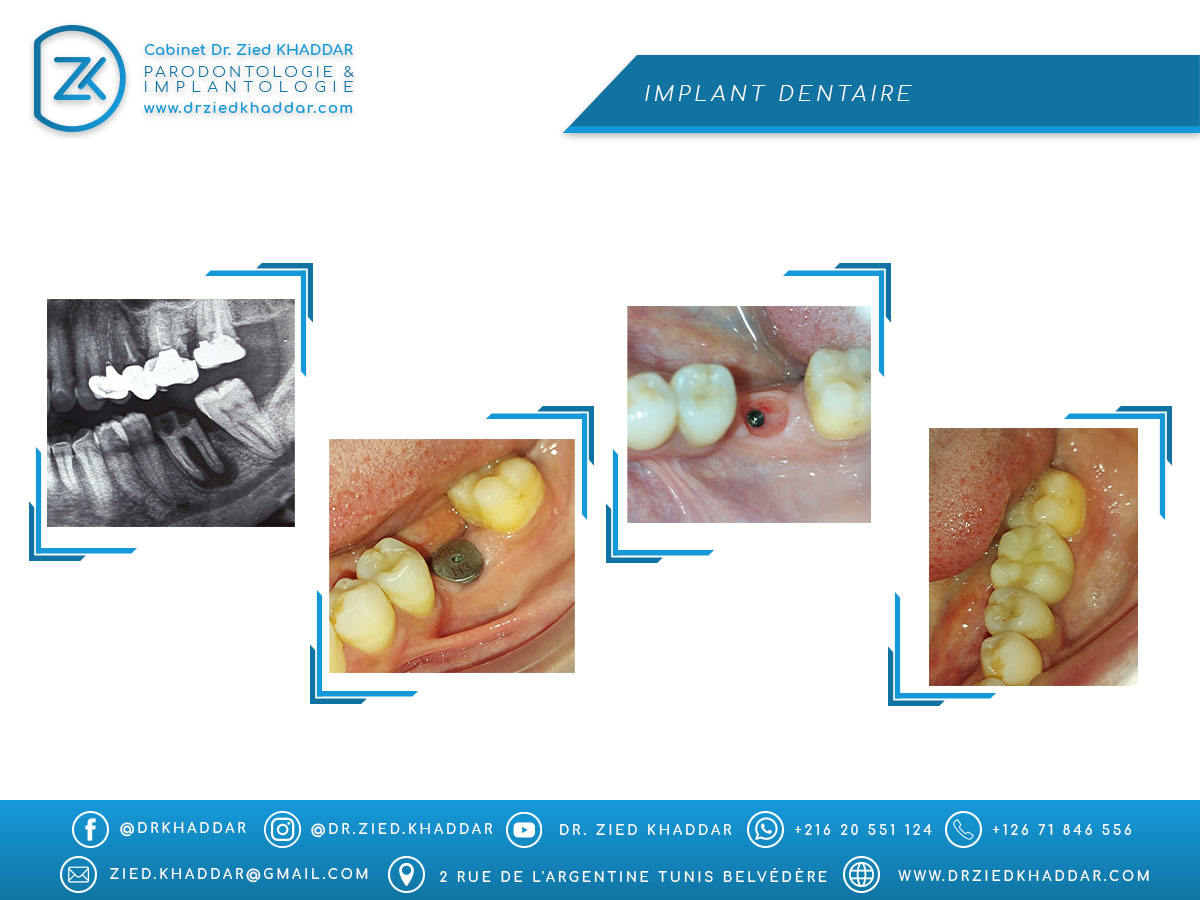 Implant dentaire