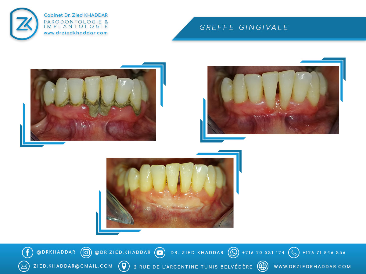 Greffe gingivale 