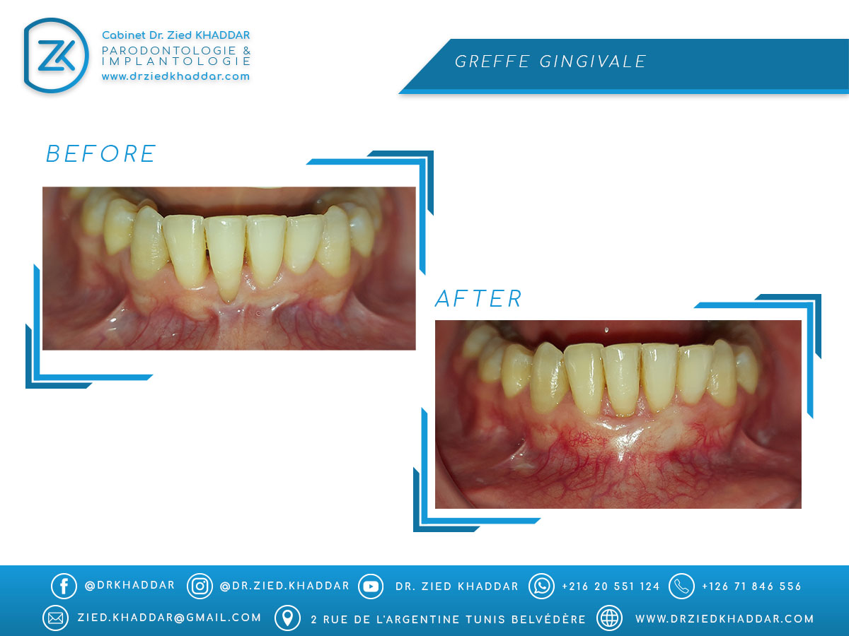 Greffe gingivale 