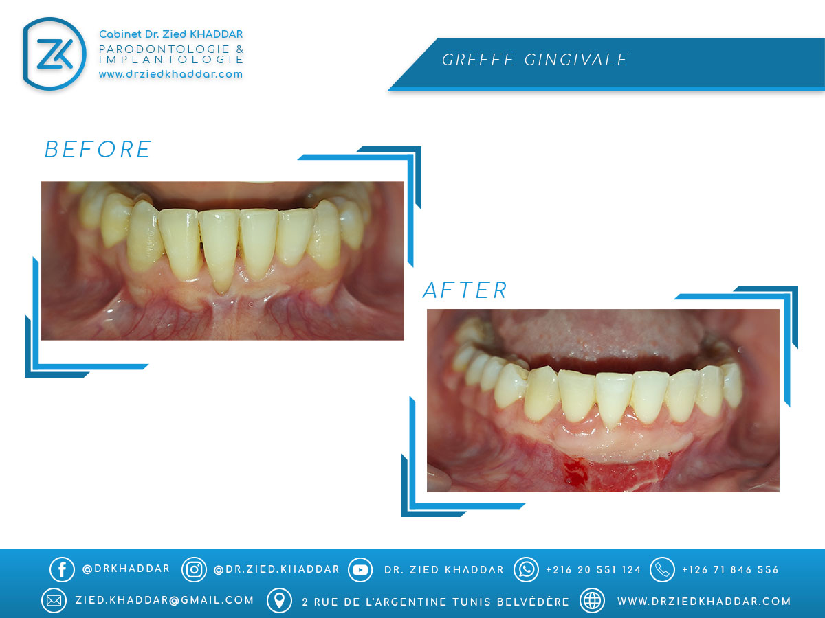 Greffe gingivale 