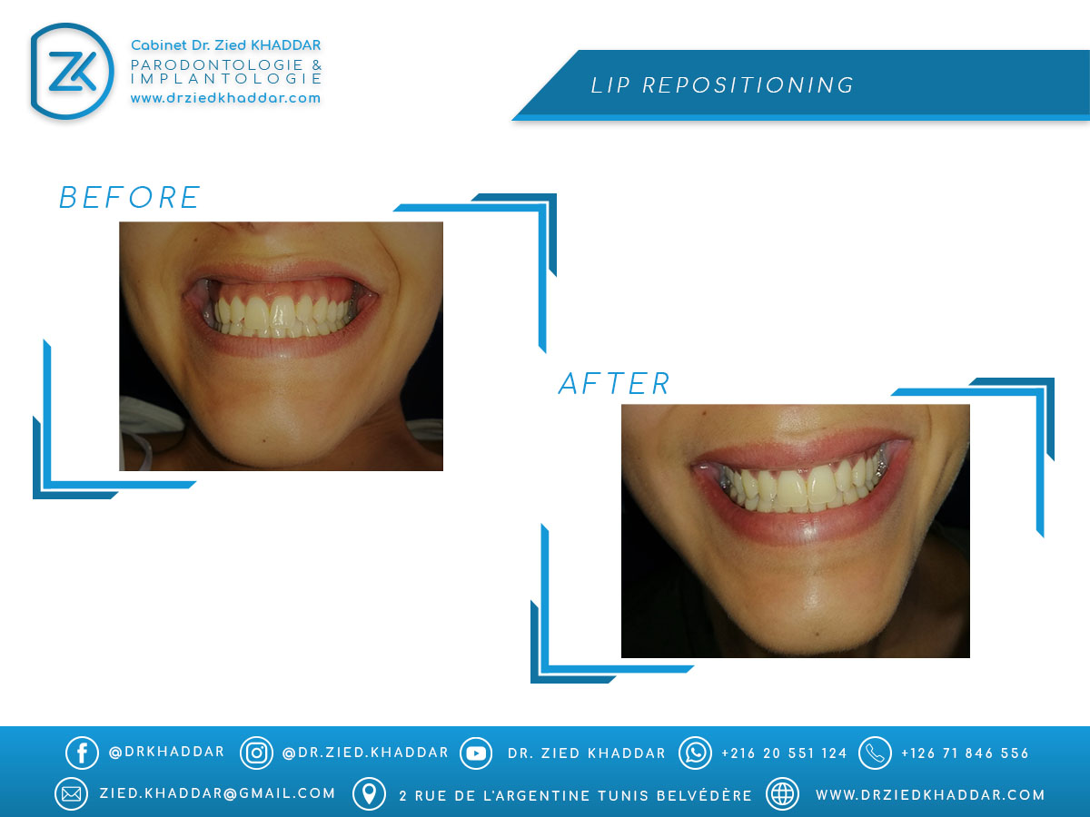 Correction du sourire gingival (Lip repositioning)