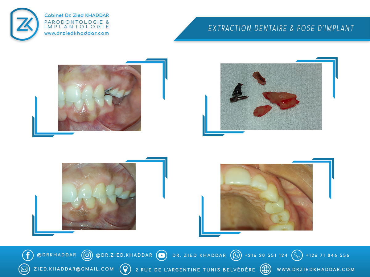 Extraction dentaire & Pose d’implant 