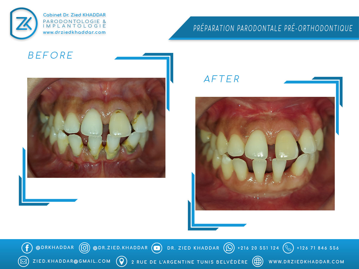 Préparation parodontale pré-orthodontique 