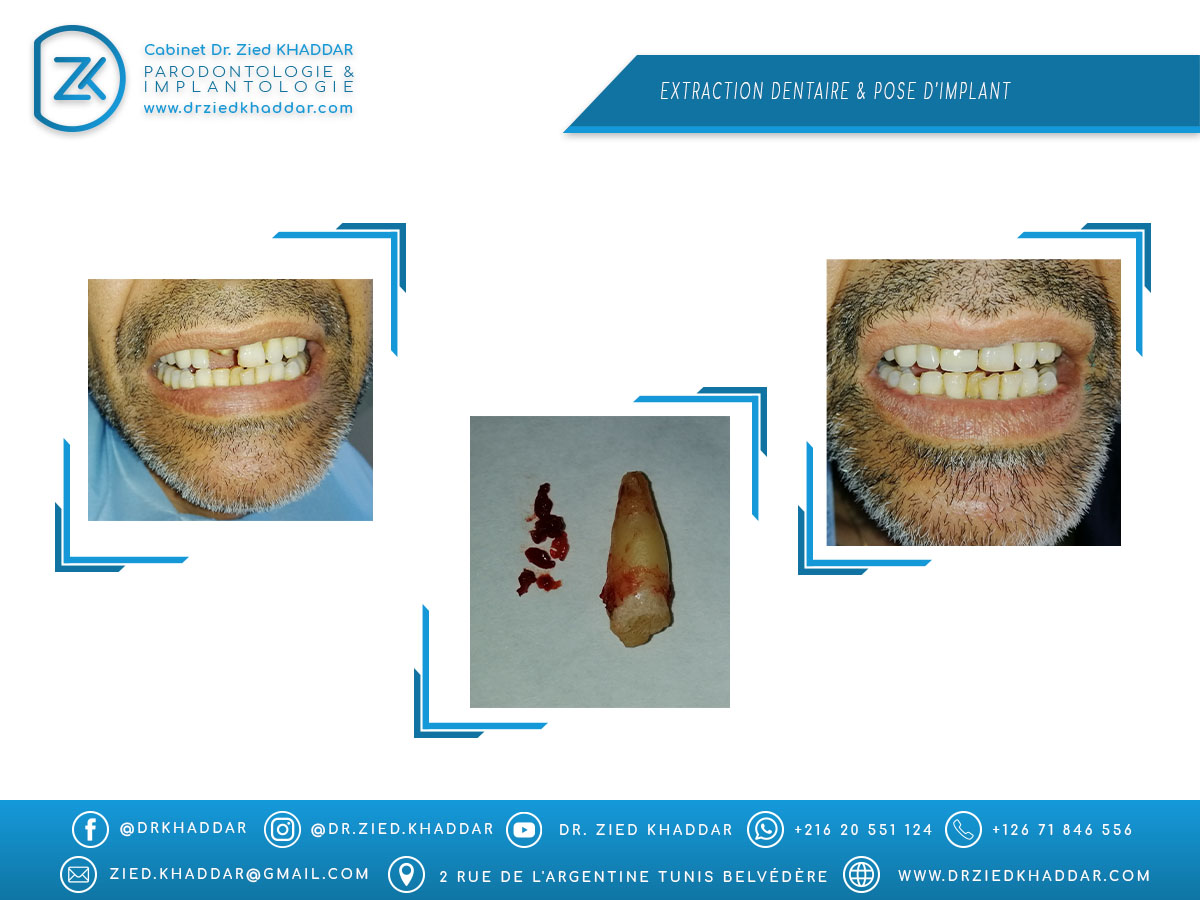 Extraction dentaire & Pose d’implant 