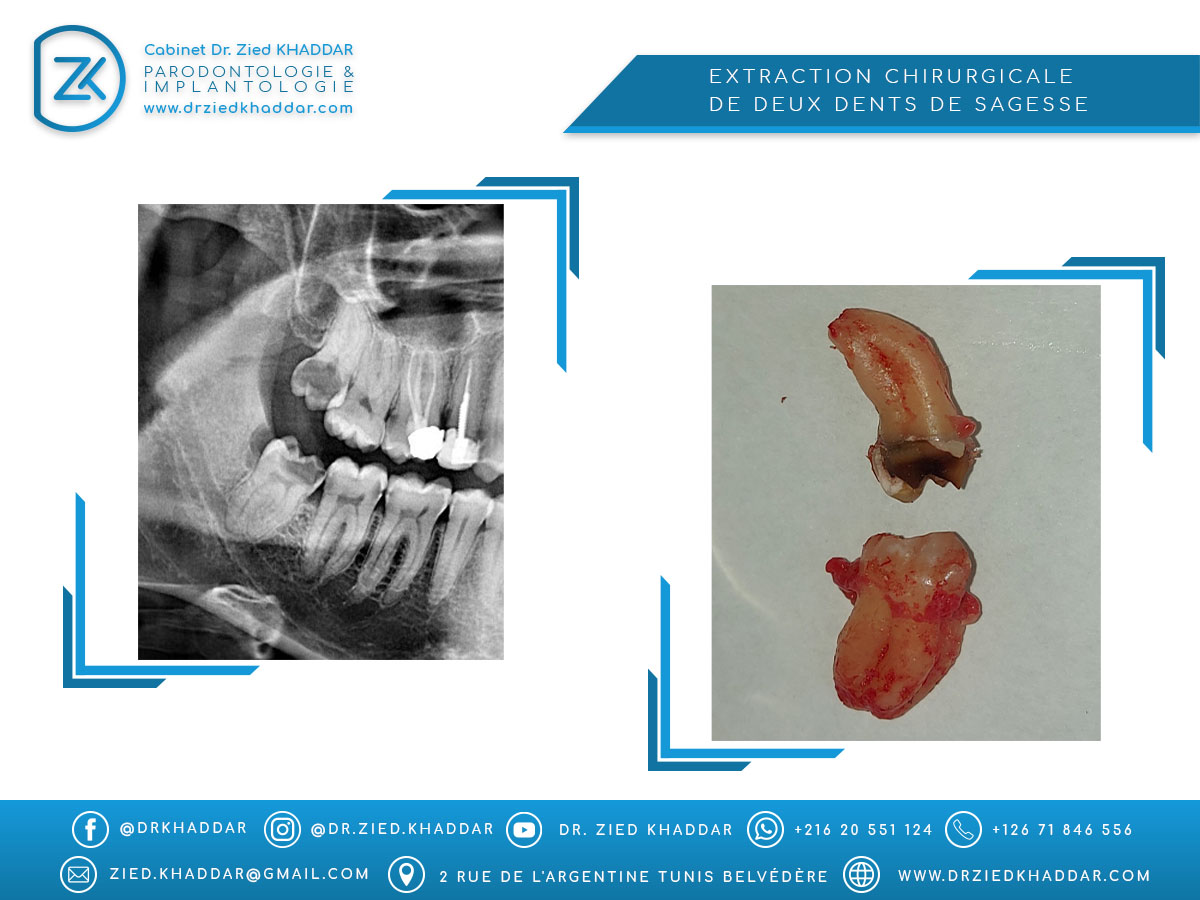 Extraction chirurgicale de deux dents de sagesse  