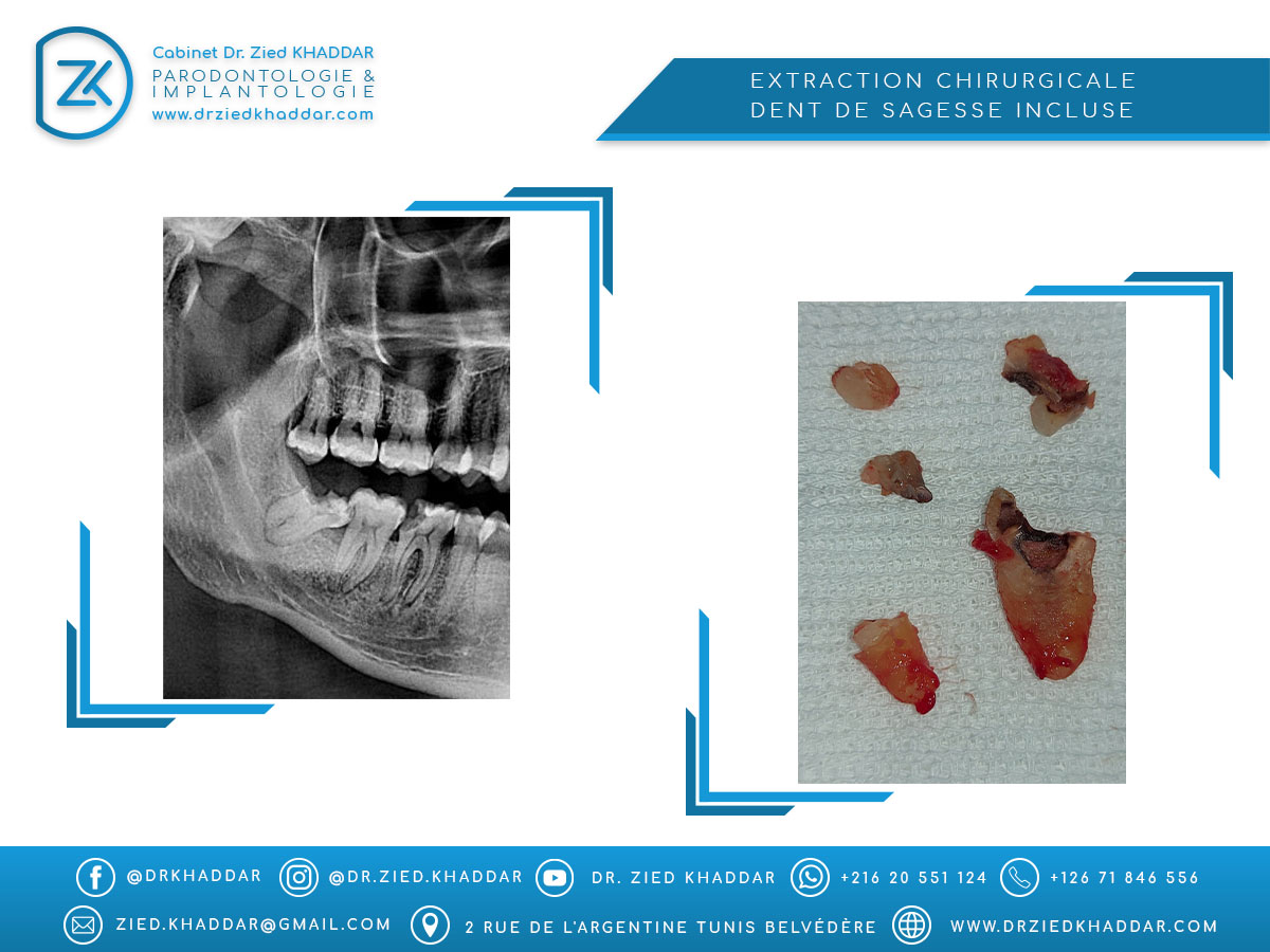 Extraction chirurgicale / Dent de sagesse incluse