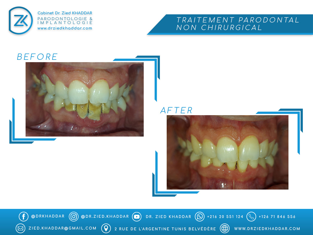 Traitement parodontal non chirurgical 