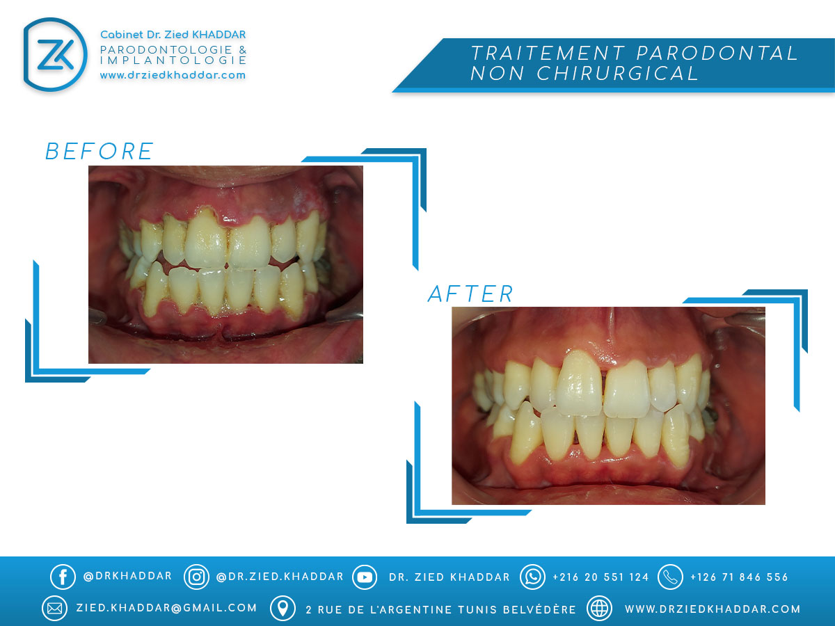 Traitement parodontal non chirurgical