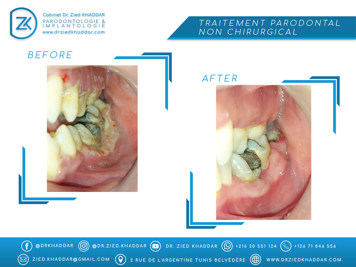 Traitement parodontal non chirurgical 