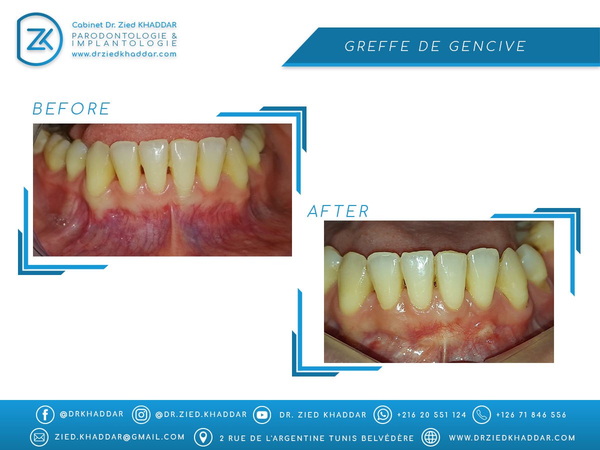 Greffe de gencive 