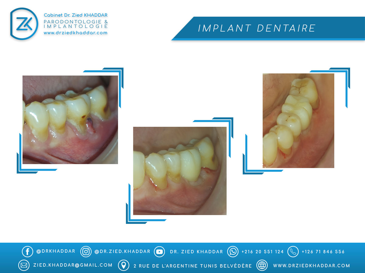 Implant dentaire