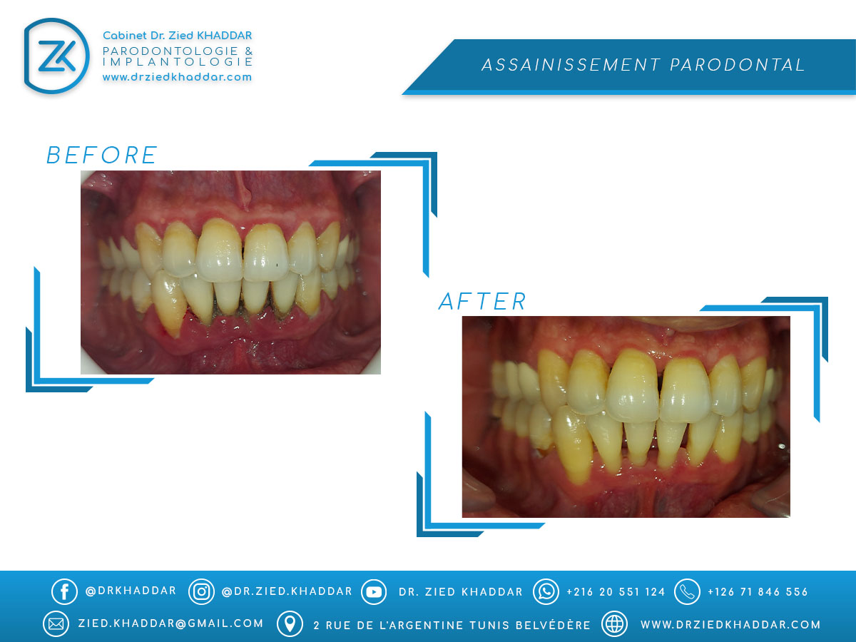 Traitement parodontal non chirurgical 