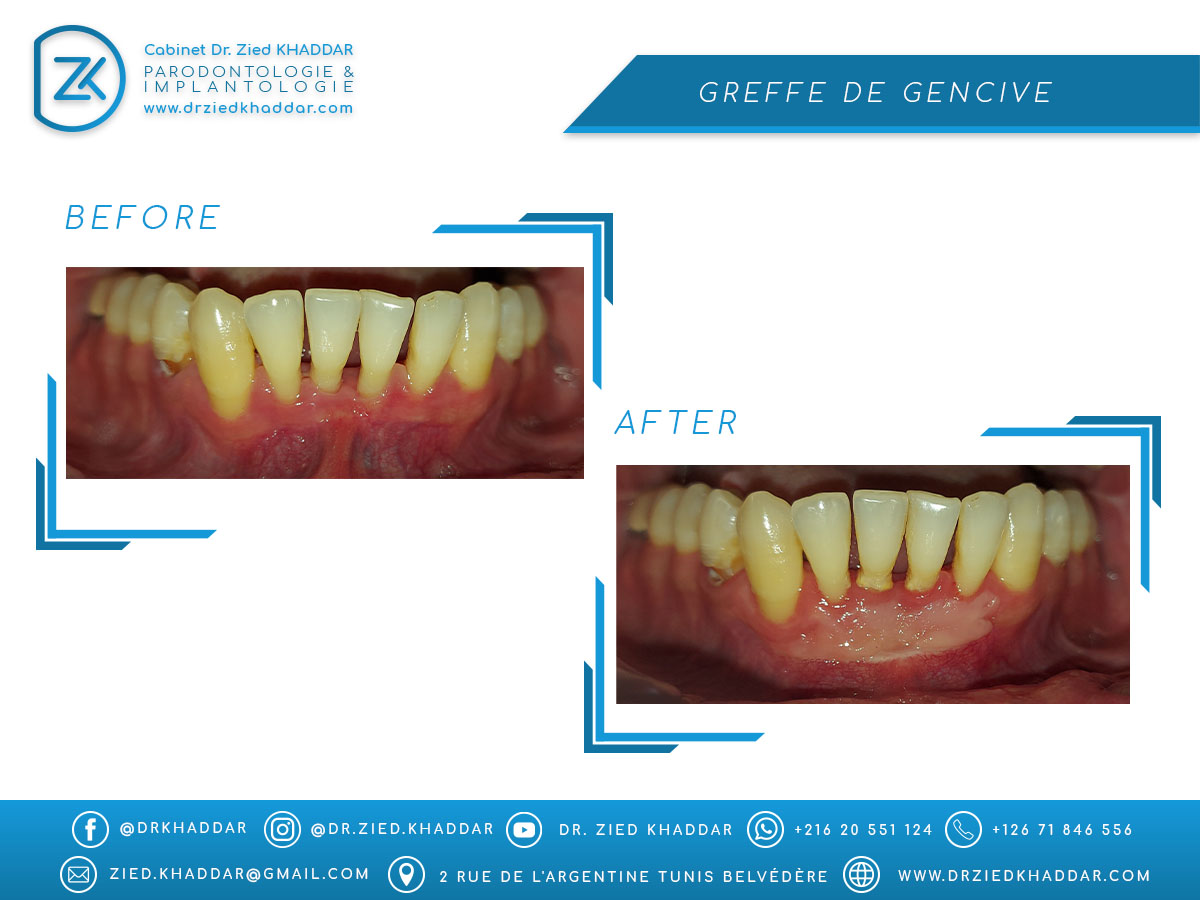 Greffe de gencive 