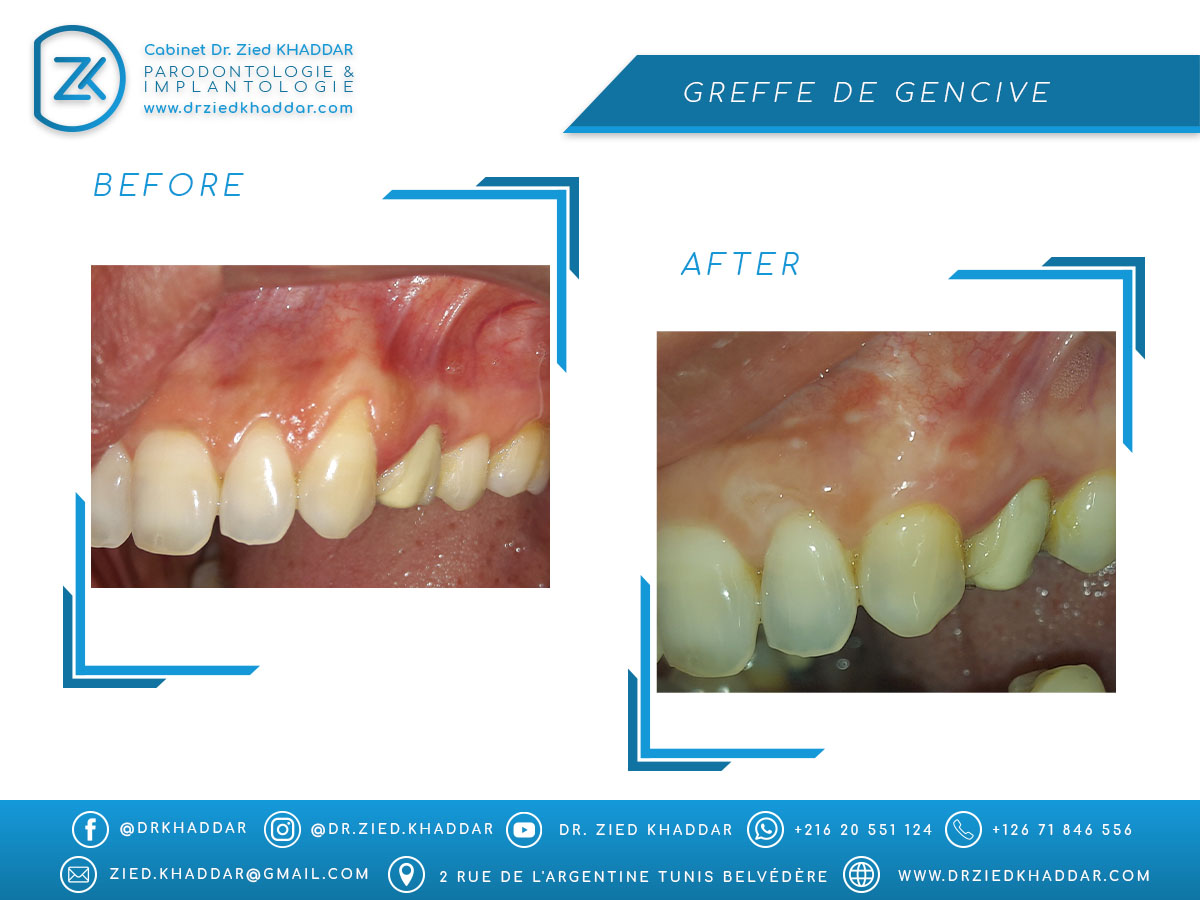 Greffe de gencive 