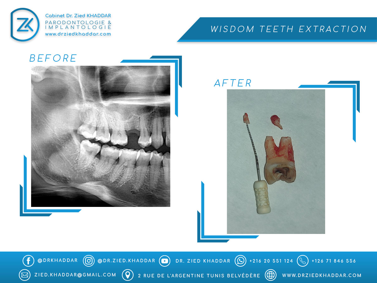 Wisdom teeth extraction 