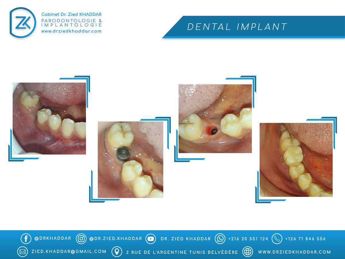 Dental Implant