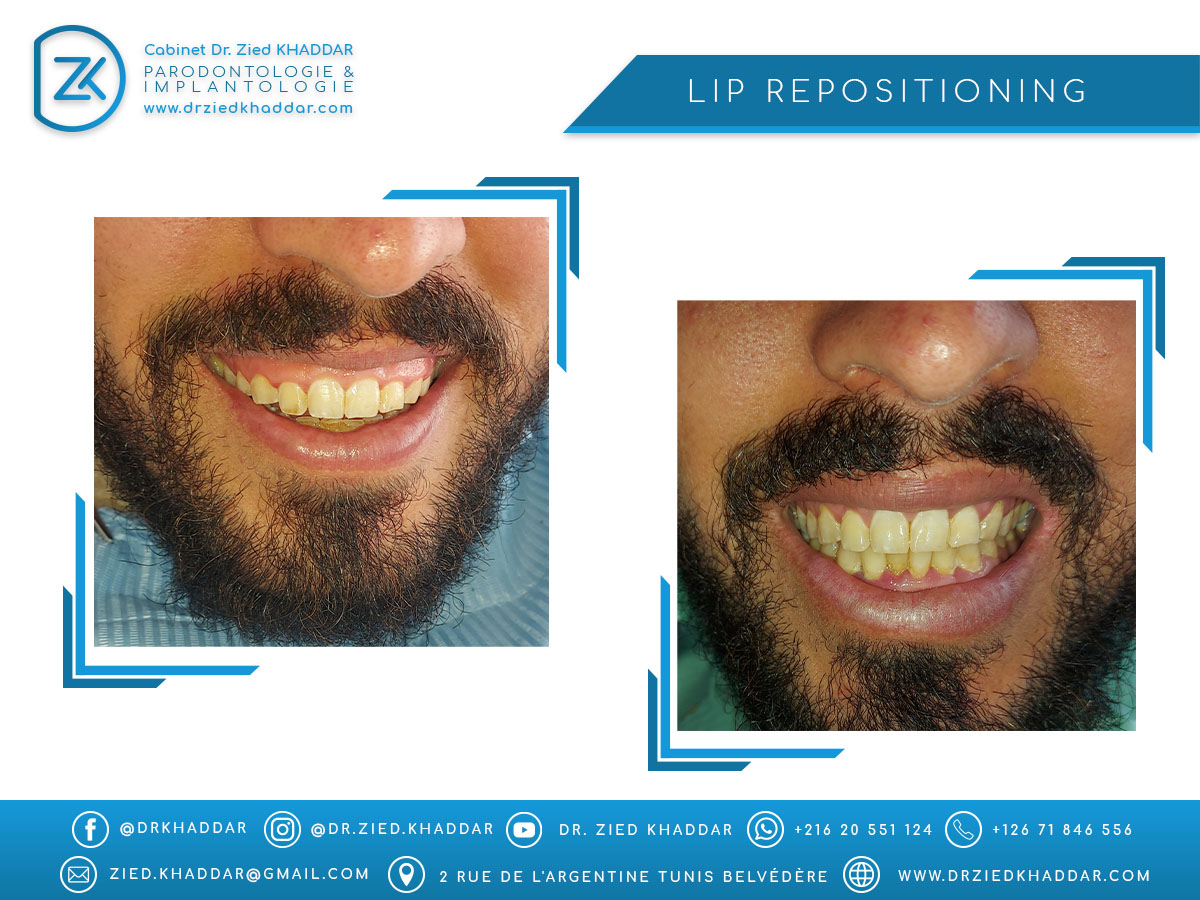 Lip repositioning surgery
