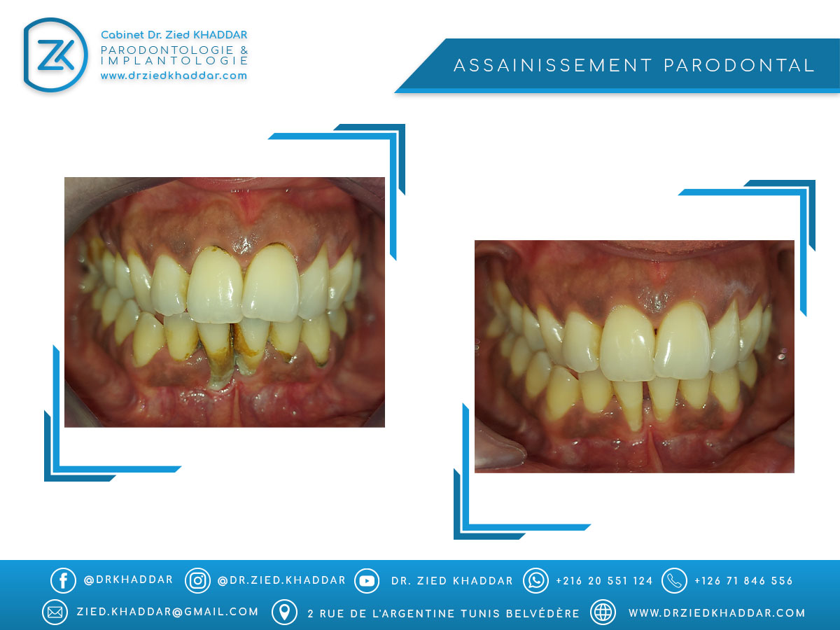 Assainissement parodontal