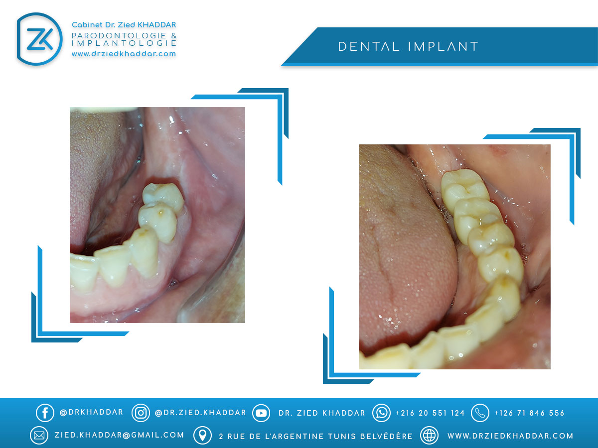 Dental Implant