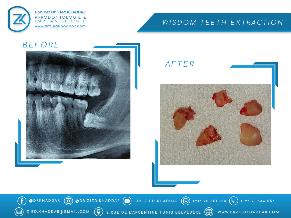 Wisdom teeth extraction 