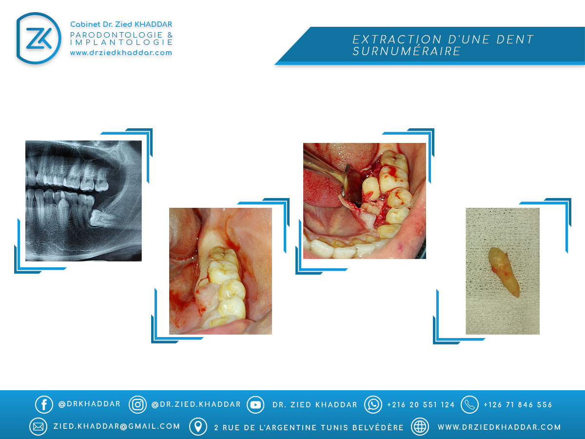 Extraction d'une dent surnuméraire 