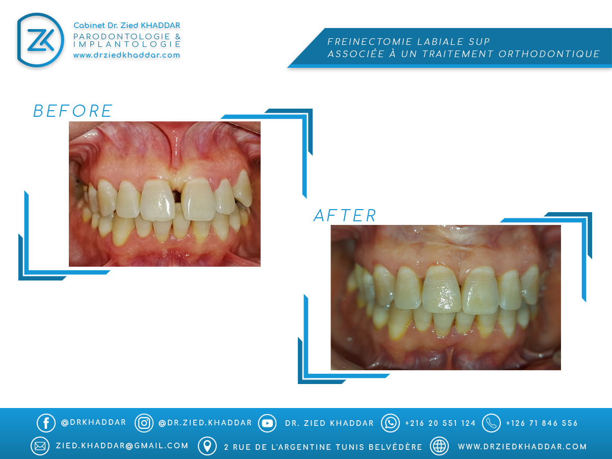 Freinectomie labiale sup associée à un traitement orthodontique 