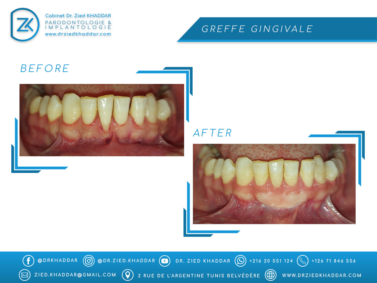 Greffe gingivale 