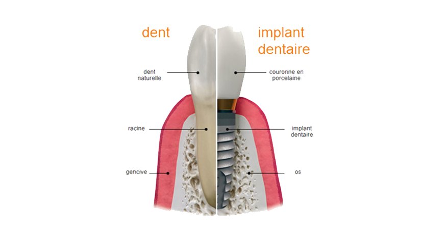 implantologie